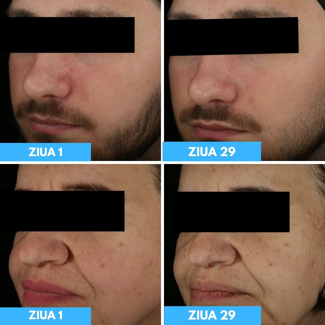 Sebio Biome DS - Before and After (1)