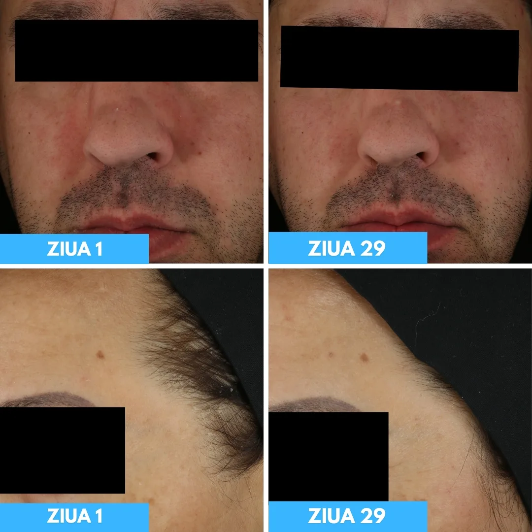 Sebio Biome DS - Before and After (2)