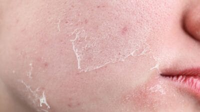 Piele uscată și sensibilă: de ce se usucă tenul și rutina care îl repară