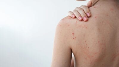 Cum să scapi de coșurile de pe spate: Ghid dermatologic