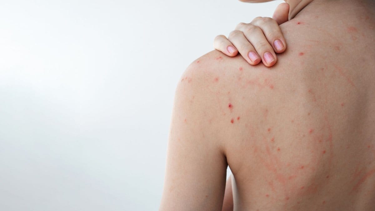 Cum să scapi de coșurile de pe spate: Ghid dermatologic