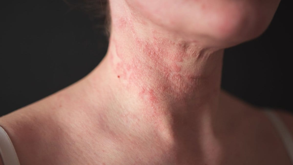 Îngrijirea pielii atopice: Ghid de la dermatolog